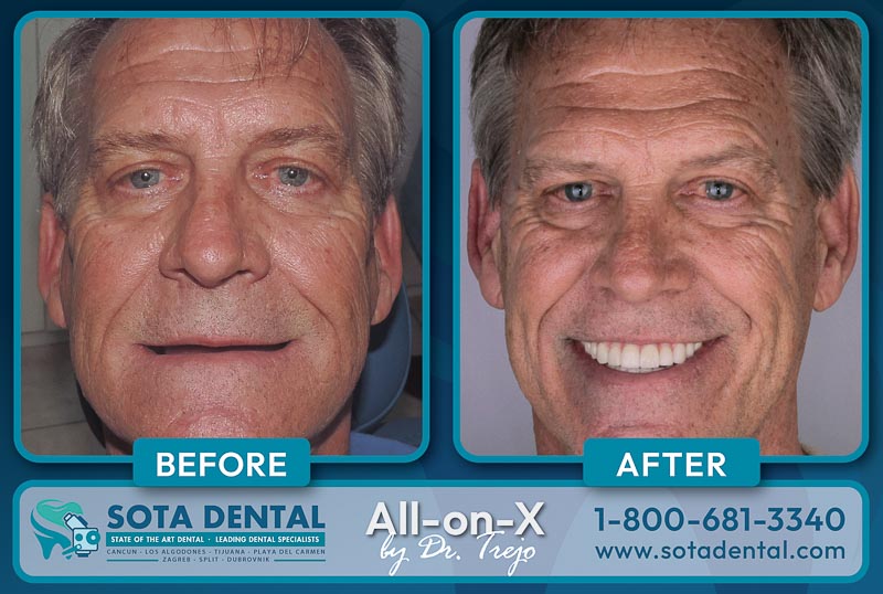 An older male all-on-4 patient at SOTA Dental Mexico shows his teeth before and after her procedure. He had no teeth before, and now he has straight and white teeth.