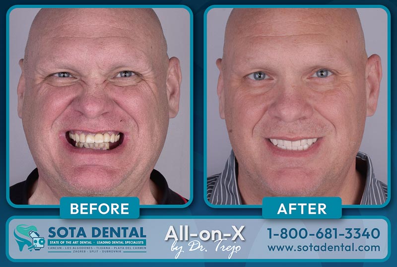 A middle-aged male all-on-4 patient at SOTA Dental Mexico shows his teeth before & after surgery. His teeth were damaged and now there are straight and white.