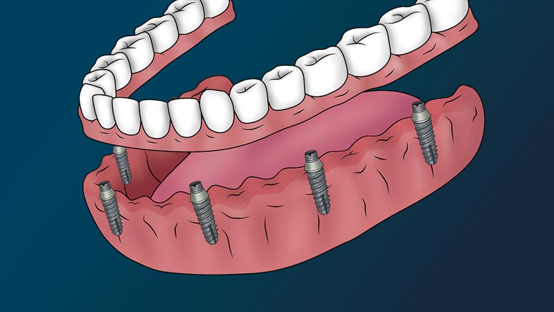 A full arch with no teeth. A full arch of teeth is just above the dental implants, but not yet connected.