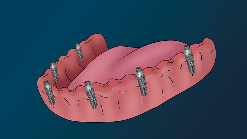 A full arch with no teeth. There are six dental implants in the gums and six abutments are connected to them.