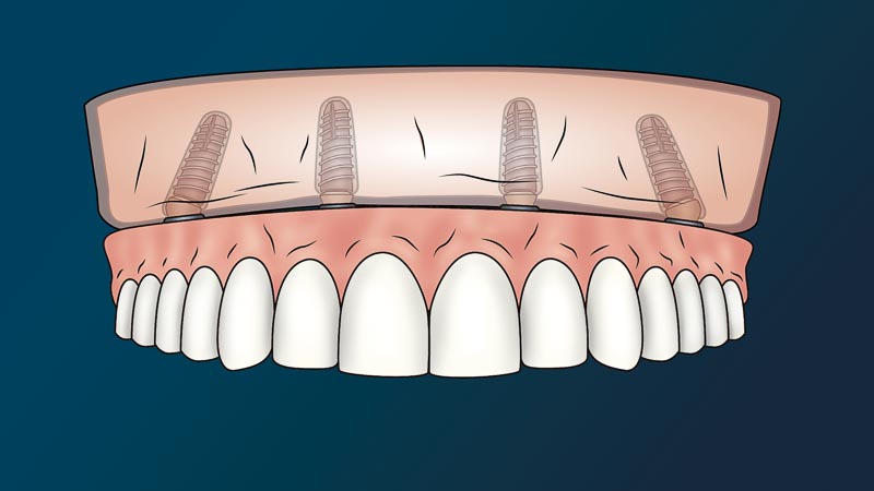 A transparent front view of a mouth. 4 dental implants can be seen through the transparent gums.