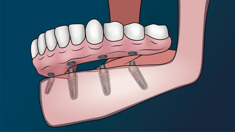 A transparent side view of a mouth. 4 dental implants can be seen through the transparent gums. A full arch of teeth is about to be connected to the abutments above the implants.