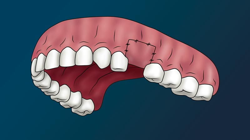 A full arch of teeth with one missing tooth. It is stitched up around the gums.