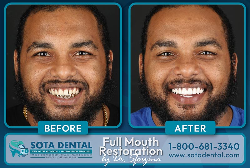 A middle aged patient from SOTA Dental in Cancun showing the before and after changes of his full mouth restoration case. His old teeth are damaged and gold but his new teeth are very white.