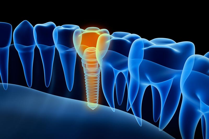 A digital rendering of eight teeth. One tooth has a dental implant is stands out from the rest.