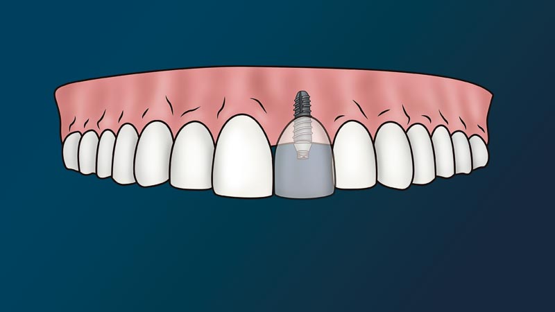 A full arch of teeth with one missing tooth. The missing area has a dental implant. A crown is attached to the dental implant. The crown is transparent to show the abutment attachment.