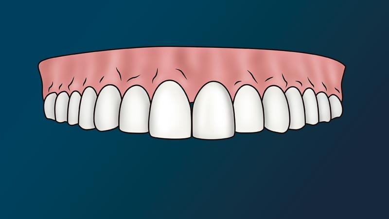 A full arch of of healthy teeth. The dental implant is no longer visable.