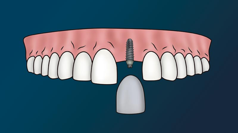 A full arch of teeth with one missing tooth. The missing area has a dental implant. A crown is just below the dental implant but not attached.