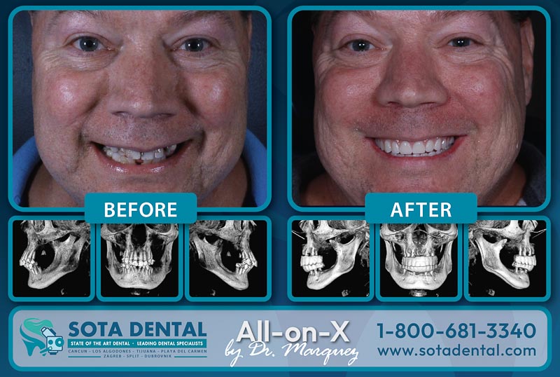 A older male patient from SOTA Dental Los Algodones with a before and after smile. His teeth were damaged before, but now are very white and straight. There are also CT scans of with before & after results. All-on-4 in Los Algodones by Dr. Marquez.