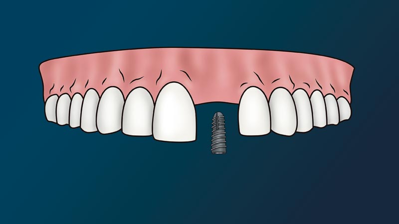 A full arch of teeth with one missing tooth. A dental implant is about to enter the gums.