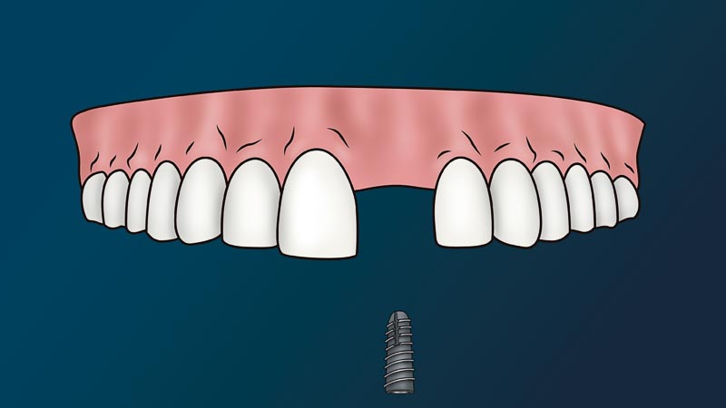 A full arch of teeth with one missing tooth.