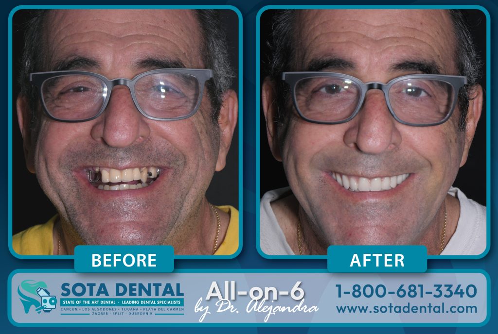 Before and After permanent dentures patient.