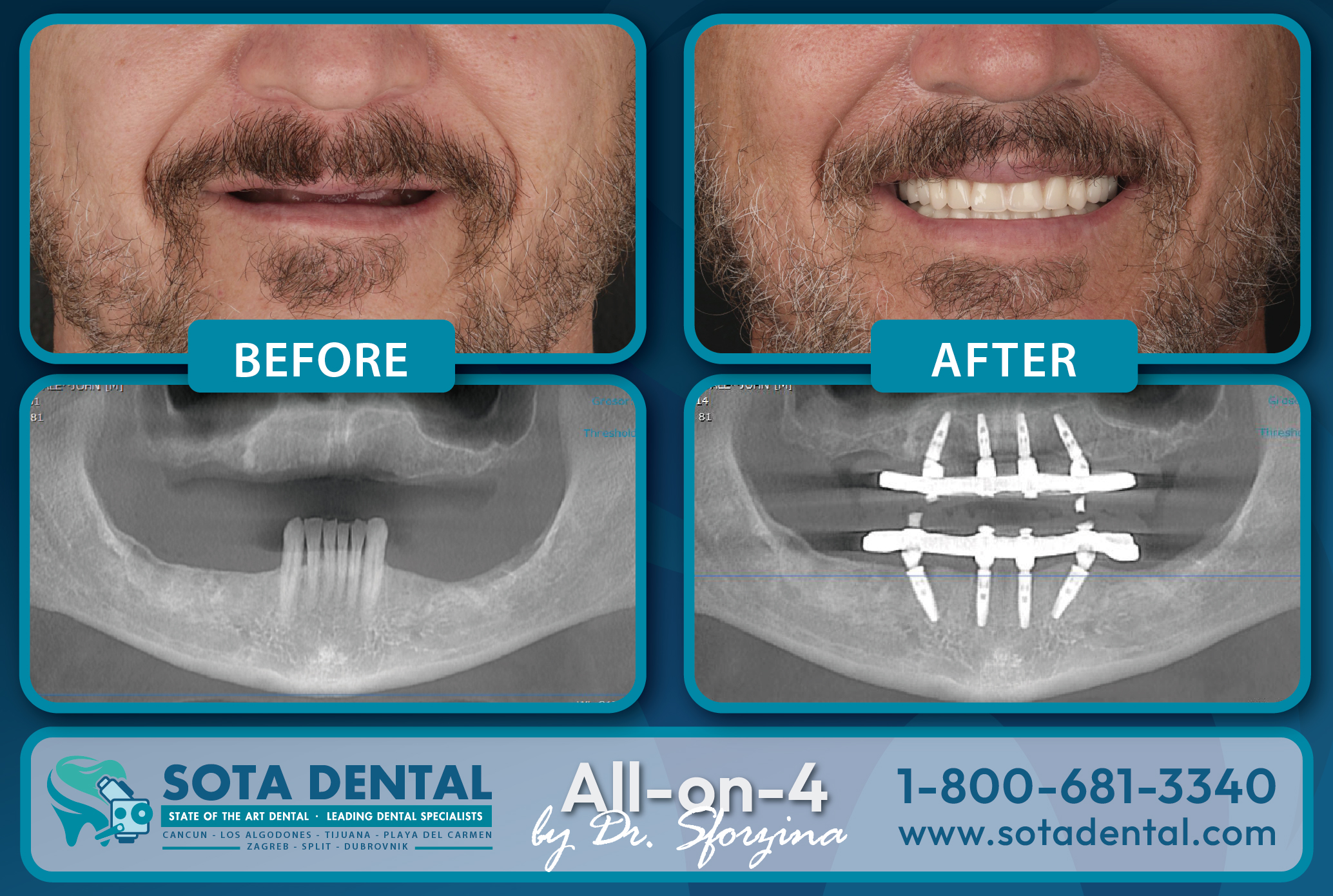 All on 4 before and after