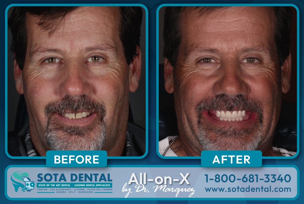 Paciente de implantes dentales completos de Los Algodones