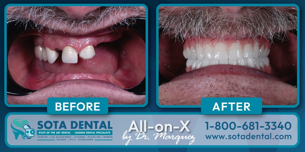 Before and After from a Permanent Denture patient in Los Algodones