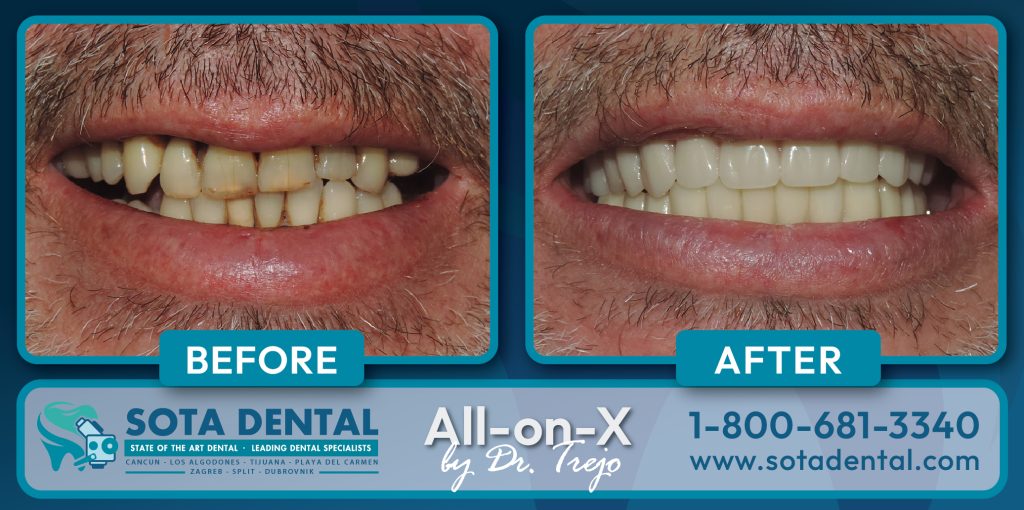 Dr. Trejo's befor and after Full Mouth Implant patient