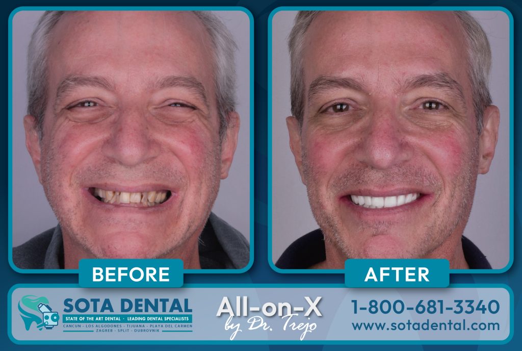 Before and After from Dr. Trejo from Tijuana