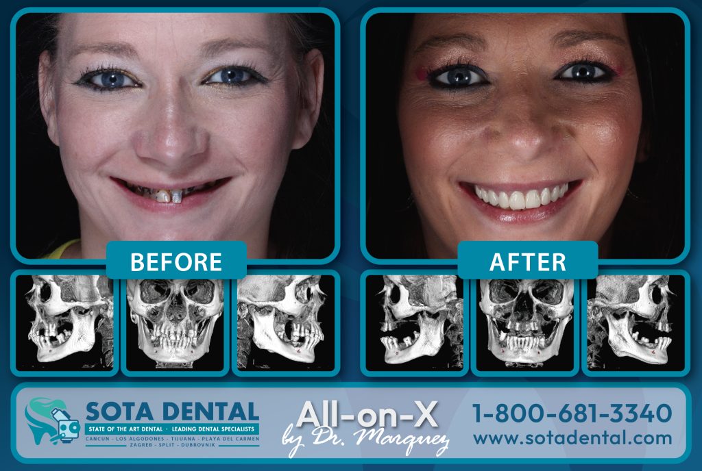 Antes y después de las dentaduras permanentes