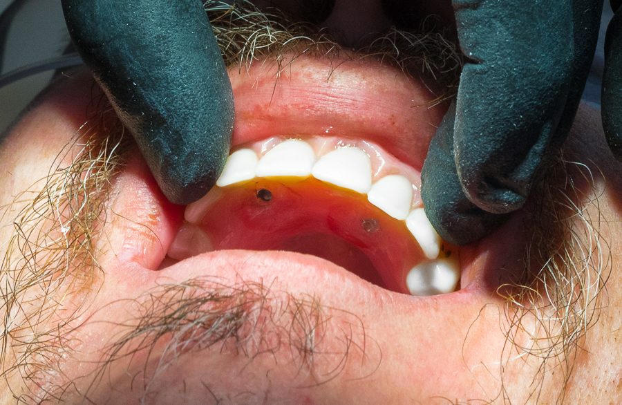 Full Mouth implants patient