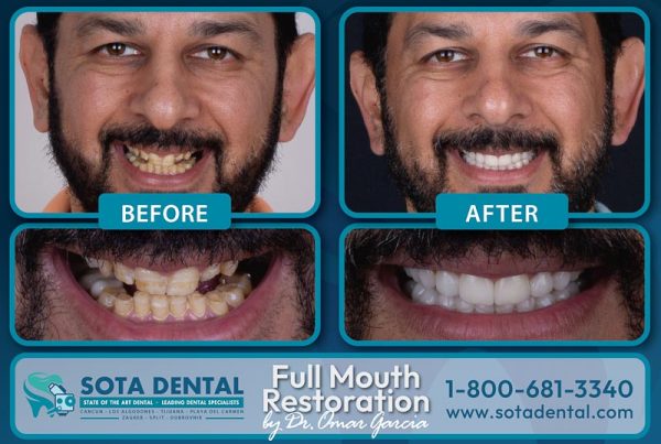 Before and after of a SOTA Dental full mouth restoration case. His teeth were damaged before and are now white and nice.