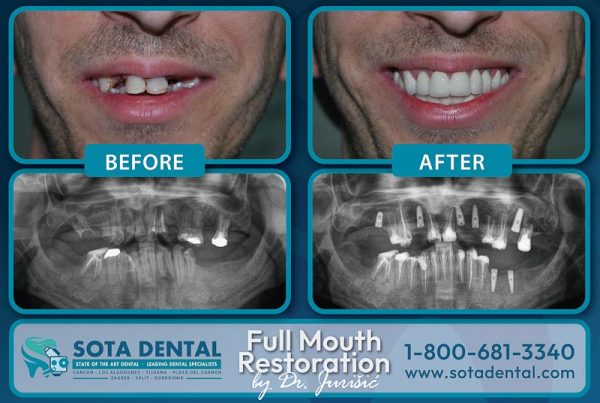 A before and after CT scan and image of a male SOTA dental patient. The teeth were damaged before and now are white and straight.