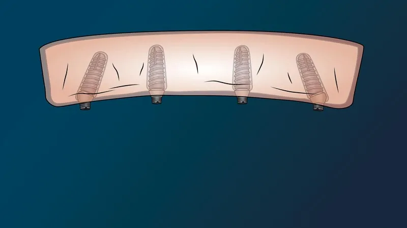 Illustration of gums showing translucent placement of the abutments of All on 4 dental implants for a perfect smile restoration in Mexico.