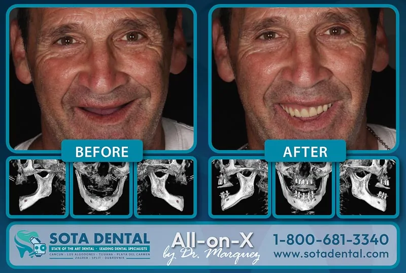 An older male patient at SOTA Dental Mexico showing his teeth before and after an All on 4 surgery in Mexico. He had no teeth, and now he has beautiful white teeth.