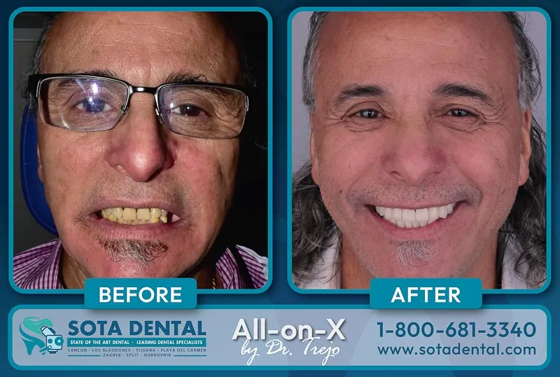 A middle-aged male patient from SOTA Dental Mexico showing his teeth before & after an All on 4 surgery. His teeth were damaged before and now he has a big white smile.