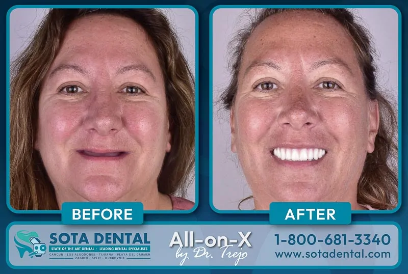 The patient smiles in two photos before and after All on 4 treatment in Mexico.