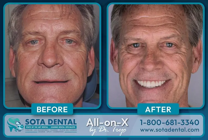 The patient smiles in two photos before and after All on 4 treatment in Mexico.