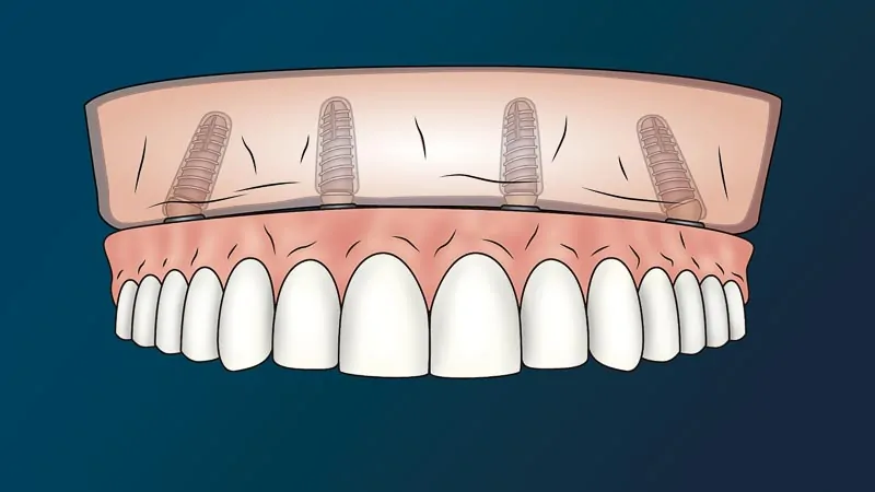 Illustration of gums showing translucent placement of All on 4 dental implants for a perfect smile restoration in Mexico.