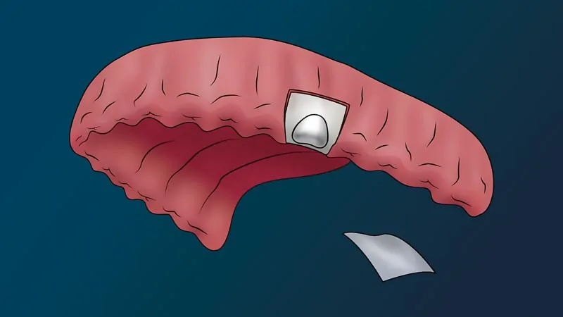 A full arch with no teeth. A piece of bone has entered a hole. A small, flat, paper-like piece looks as if it will be placed overtop of the hole.