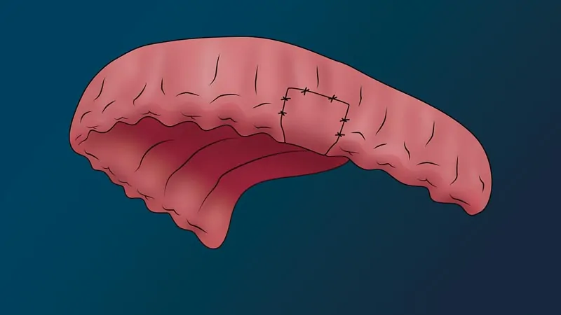A full arch with no teeth. There are stitches where the hole used to be.