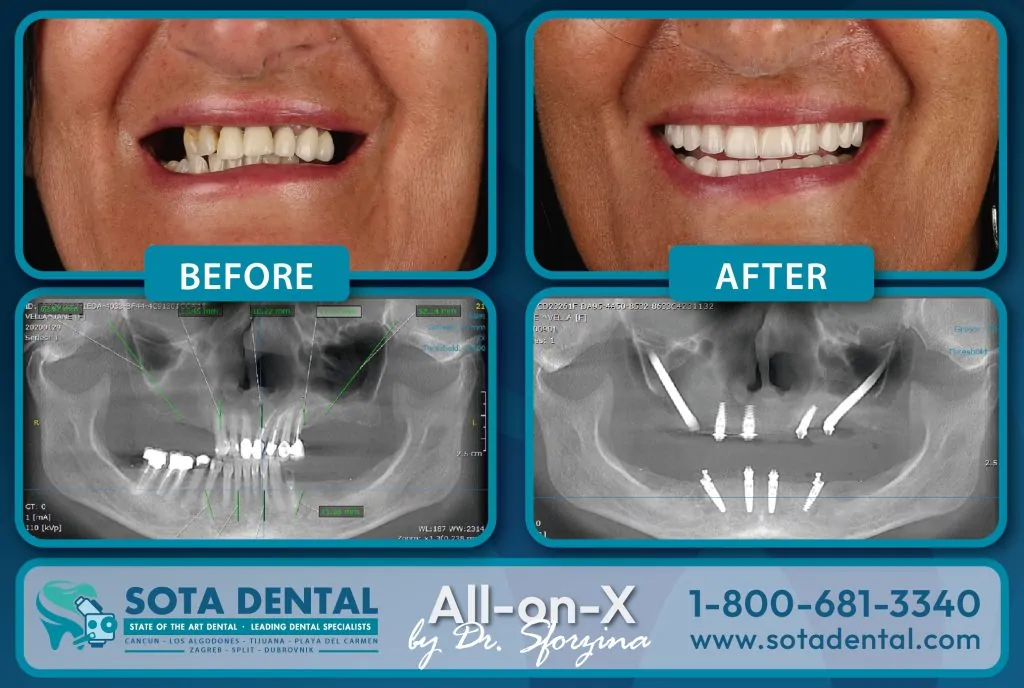 Dr. Sforzina Full Mouth Implants All on 4 Zygomatic patient.