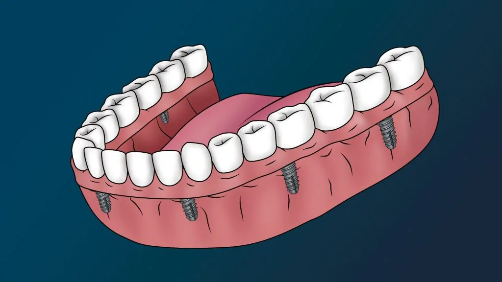 All on 4 denture Treatment