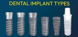 Different types of dental implants that doctors use in Mexico for All on 4 treatments.